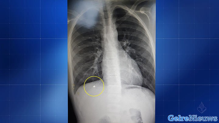 Beschoten jongen (13) moet leven met kogel in zijn lichaam